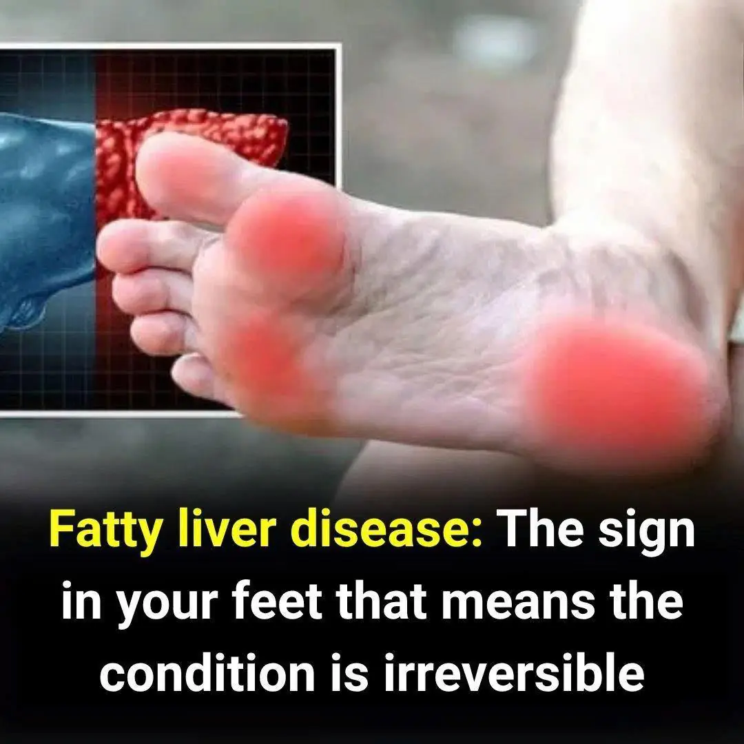 Fatty liver disease: The sign in your feet that means the condition is irreversible