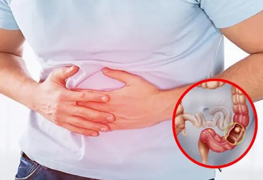 6 early warning signs of stage 1 colon can.cer you shouldn’t ignore