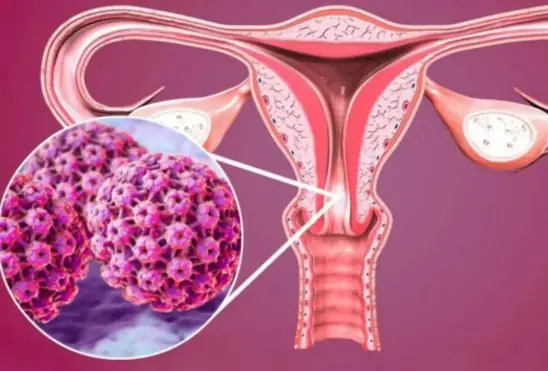 5 early warning signs of cervical can.cer