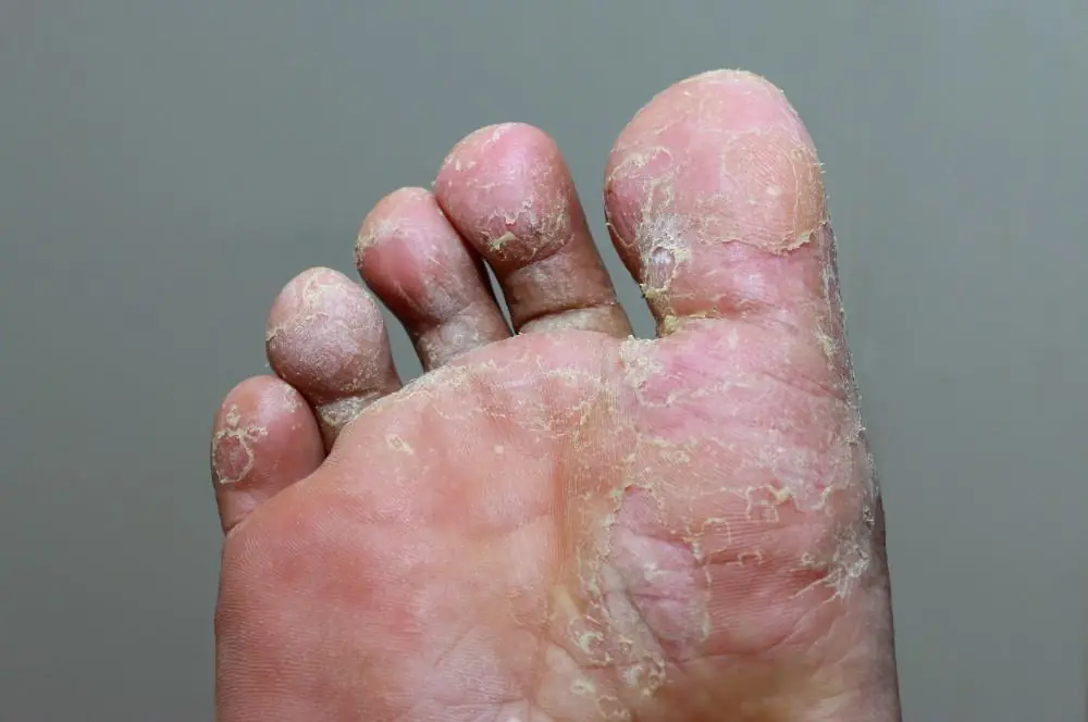 Peeling Skin on Your Feet? It Might Be More Serious Than You Think