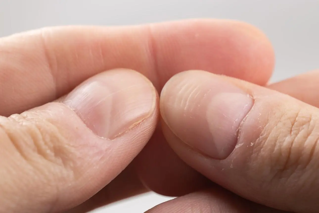 What Do Lines on Your Nails Really Mean for Your Health?