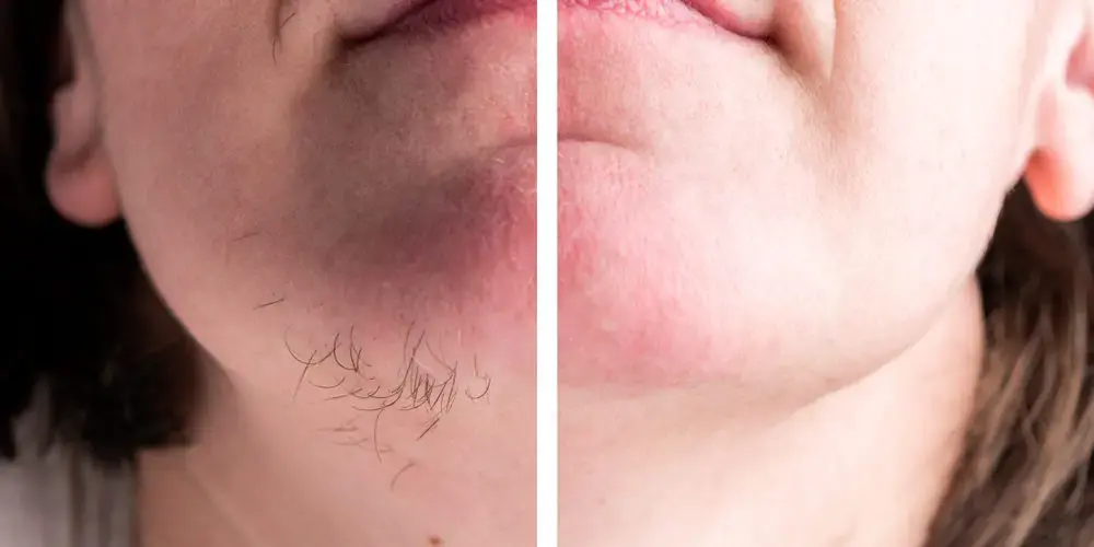 “If You’re a Woman and Notice Chin Hair, Don’t Ignore It — Here’s What It Could Mean”