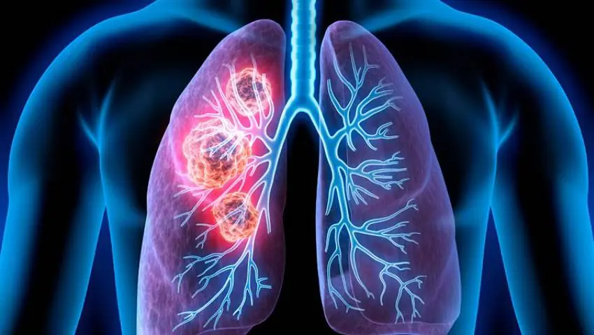 Your body may be sending signals — 9 early signs of lung cancer