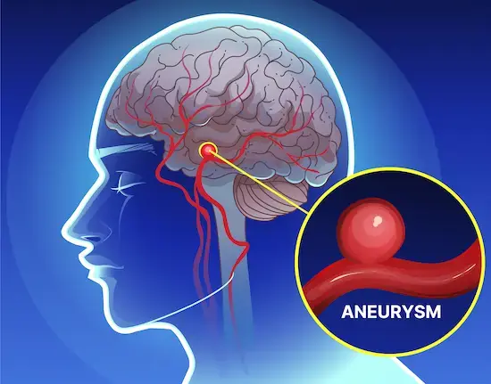Aneurysm: Recognizing the Warning Signs in Time