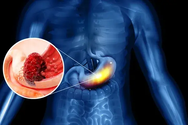 Doctors Warn: Two Everyday Fridge Items May Be Linked to Stomach Cancer