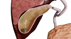 5 common symptoms that could signal the presence of gallstones in your body