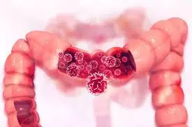 5 Quiet Warning Signs of Colon Cancer That Deserve Attention