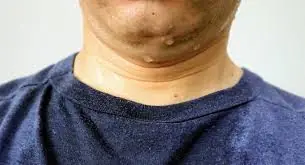 Before diagnosis: six symptoms commonly reported by lymphoma survivors