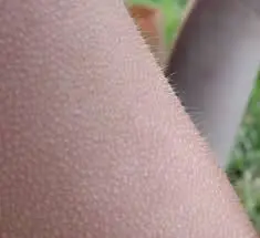 If You Get Goosebumps on Your Arms: What It Really Means (Backed by Science)