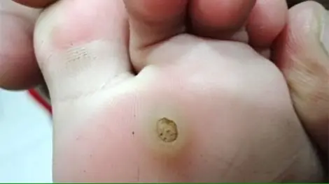 Stop Calling Them Calluses—“Fish Eyes” May Be a Viral Skin Condition