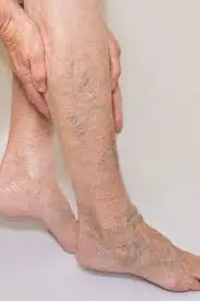 Struggling with cold feet, varicose veins, or poor circulation? Try these 6 simple steps before it gets worse