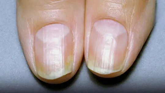 Observe Your Nails to Detect Health Issues