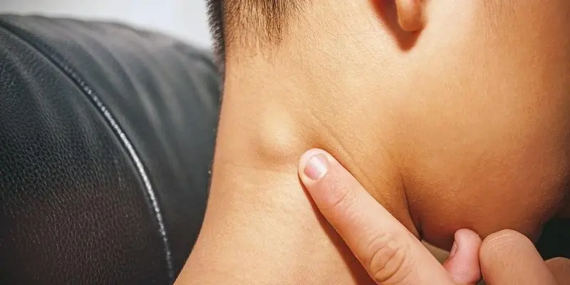 Sudden Lump in the Neck: What It Means and When to Worry