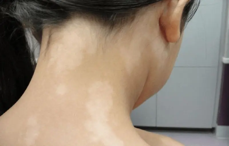 White skin spots explained: common causes beyond vitiligo you should know...