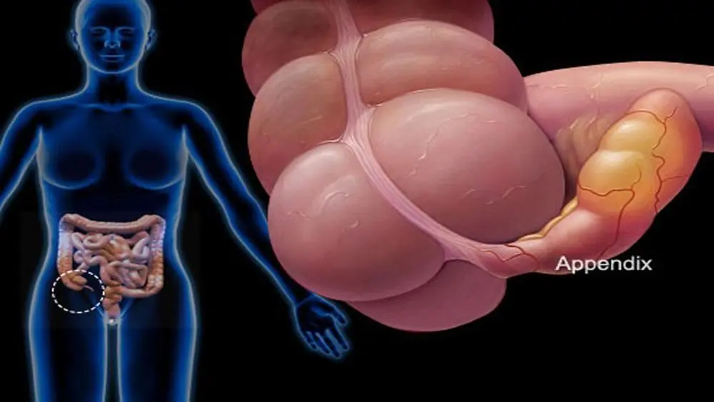 Dull Abdominal Pain Around the Navel: A Common Symptom That Could Signal Serious Conditions
