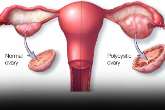 Eat 6 things to help women detoxify their ovaries and prevent gynecological diseases