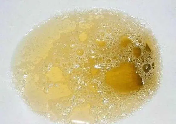 Foamy or bubbly urine: possible reasons behind this condition