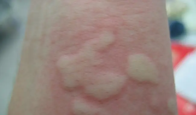 He Thought It Was Just an Allergy—Until the Diagnosis Proved Otherwise