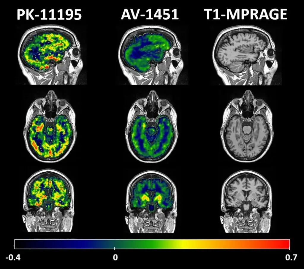 Higher Magnesium Intake Linked to Slower Brain Aging and Lower Dementia Risk, Study Finds