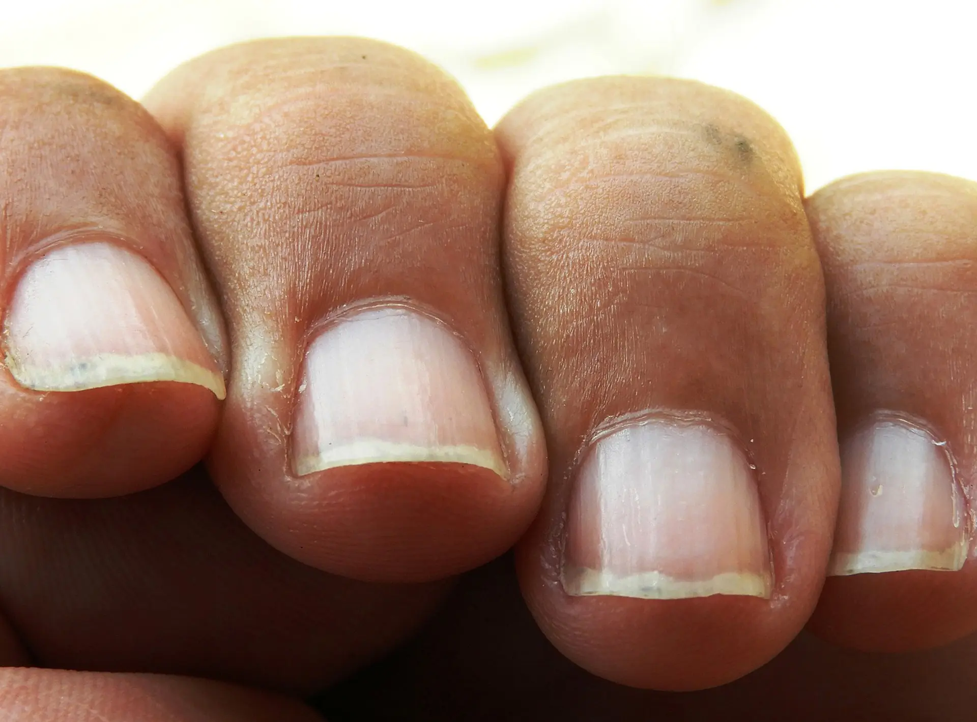 Your Nails Could Reveal Hidden Health Problems—Here’s What to Watch For
