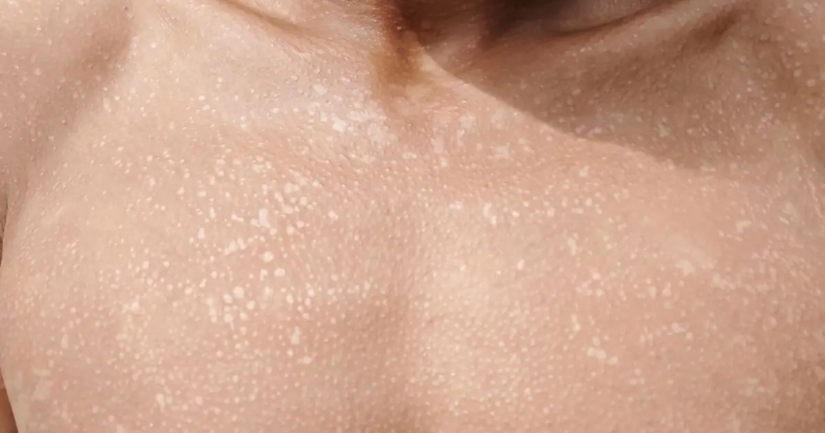 These small white spots on your arms or legs aren’t random… Here’s what a specialist reveals