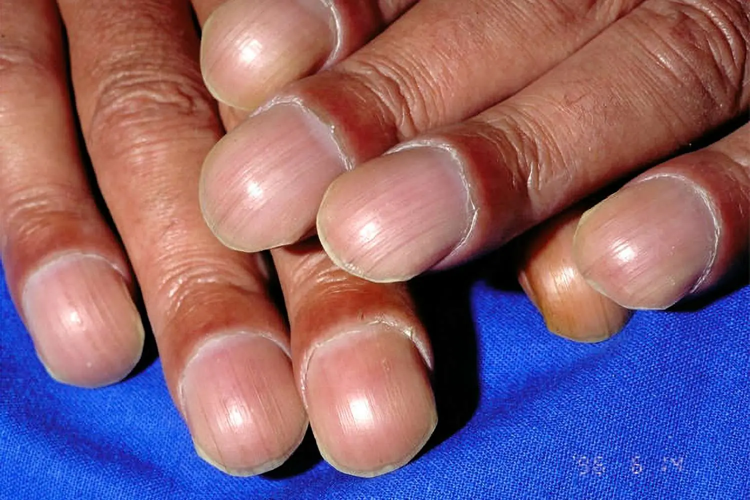 What looks like a small change in your fingers could be linked to early signs of lung cancer