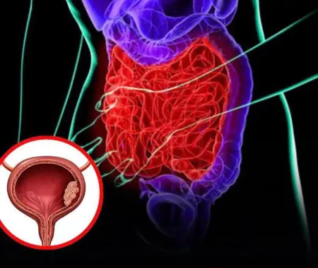 Bladder C.a.ncer: 5 Subtle Early Symptoms to Watch Out For