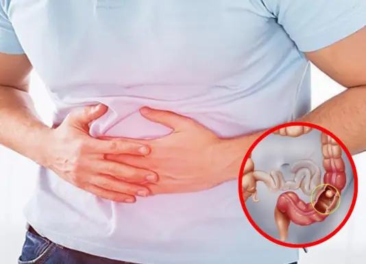 6 early warning signs of stage 1 colon can.cer you shouldn’t ignore
