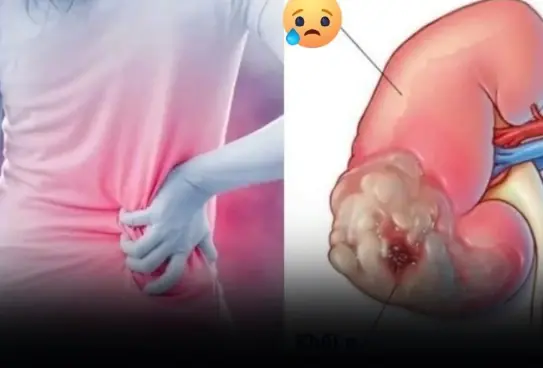 Silent signs of kidney can.cer are easily overlooked