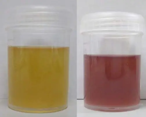 What the Color of Your Urine Is Trying to Tell You (And Why You Shouldn’t Ignore It)