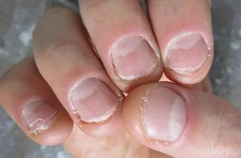 What Causes Nail Splitting? Warning Signs You Shouldn’t Overlook