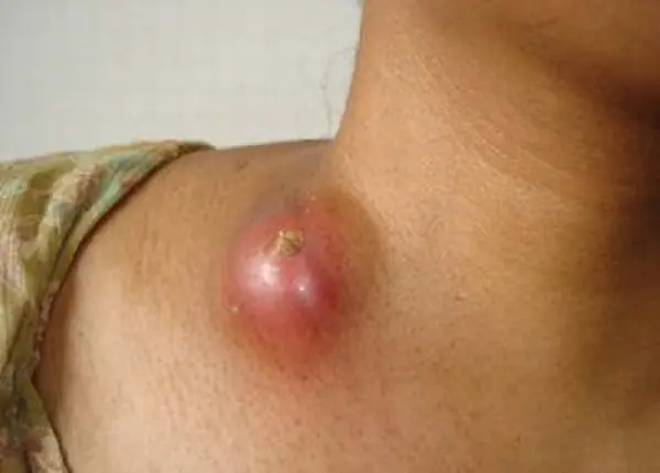 Doctors explain what lumps behind the ear or neck usually mean