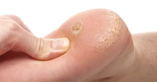 You’ll be amazed at how effortless it is to remove warts and skin tags