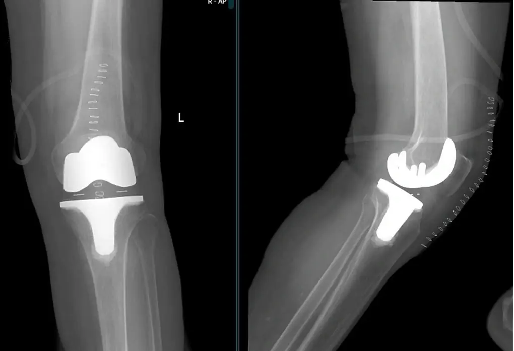 5 Hidden Early Signs of Knee Osteoarthritis Most People Don’t Notice
