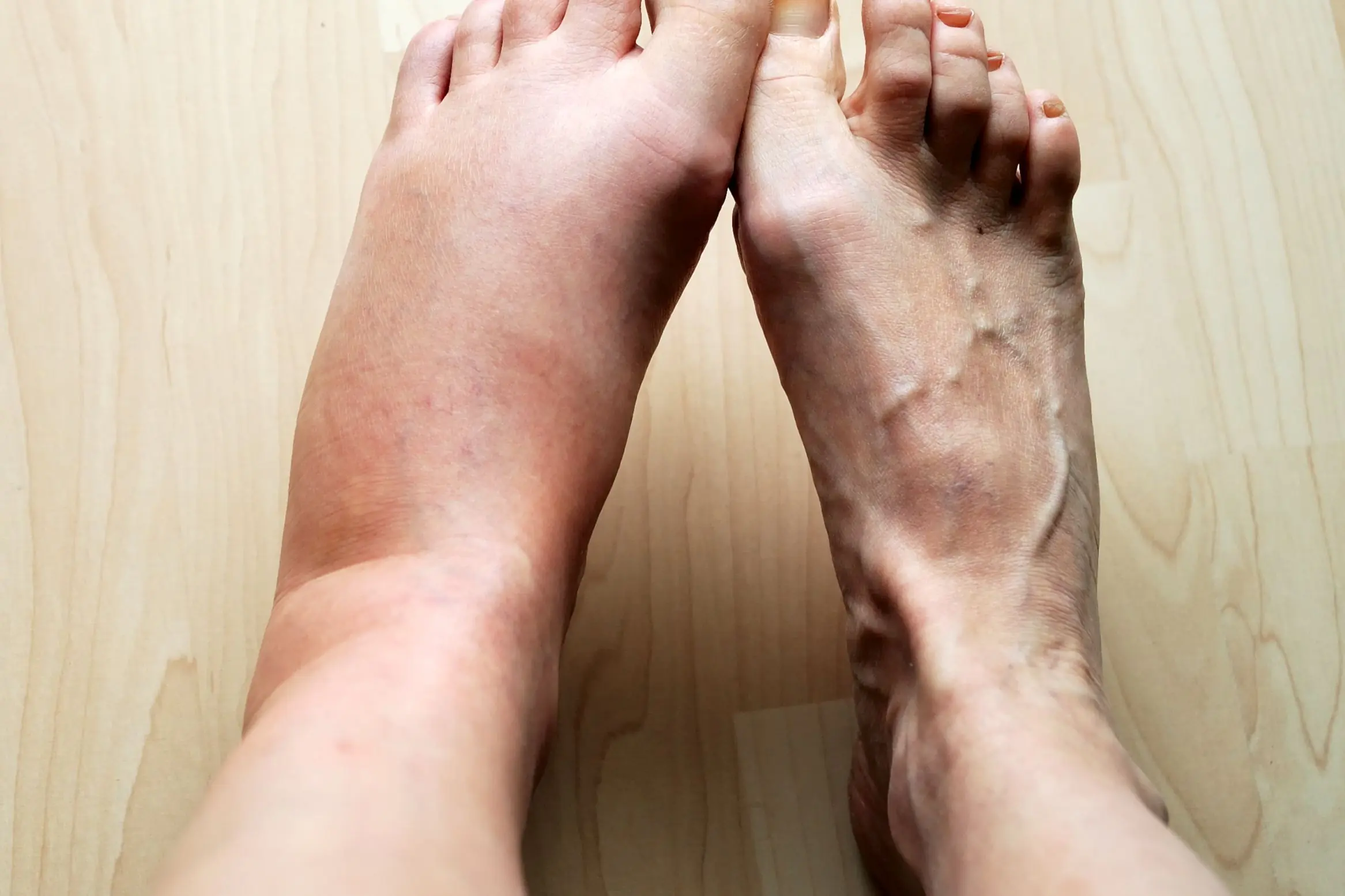 The 5 Best Nutrients to Help Reduce Swelling in Feet and Legs