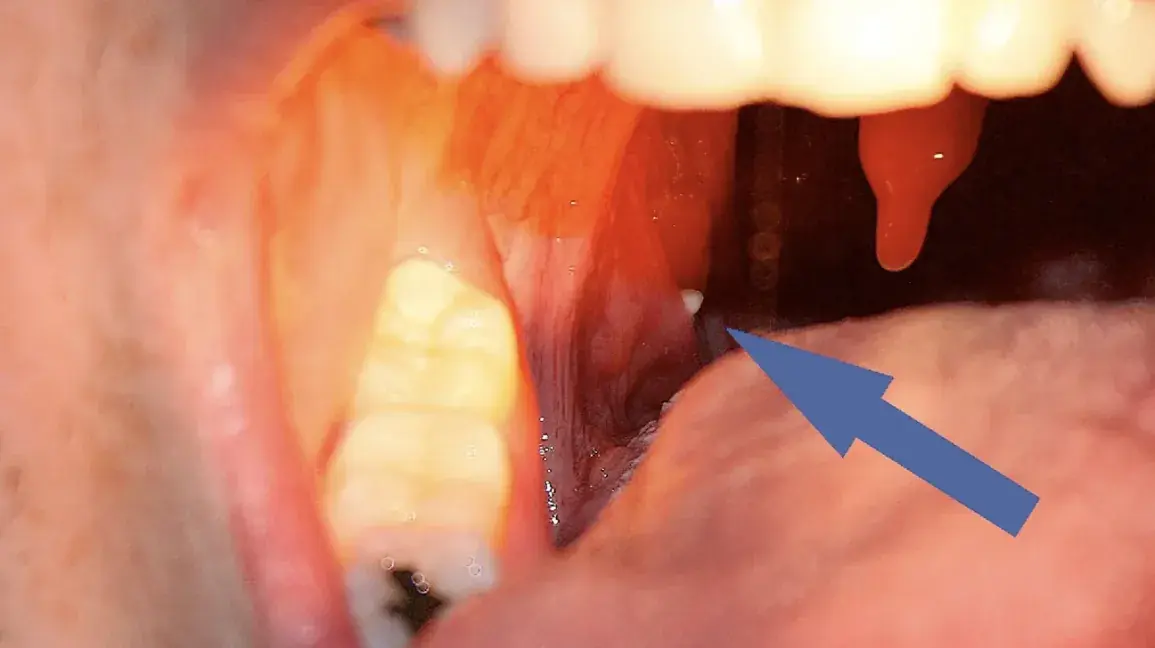 What Are Those Small, White, Smelly Balls in Your Mouth? Doctors Finally Explain