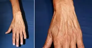 Visible Hand Veins Could Be More Than Normal — Here’s Why