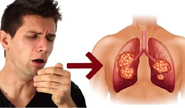 Why more non-smokers are being diagnosed with lung can.cer?
