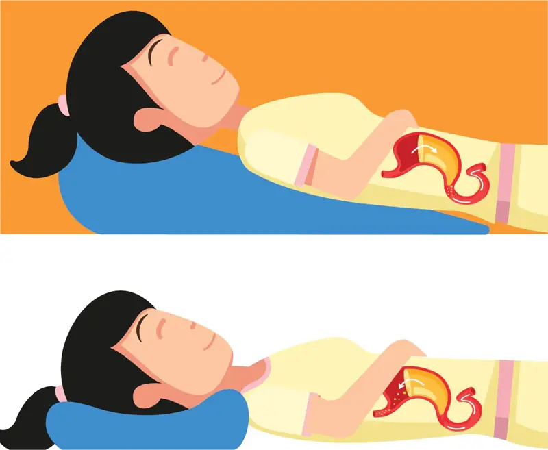 Stop Acid Reflux Naturally: 3 Proven Tips You Should Try