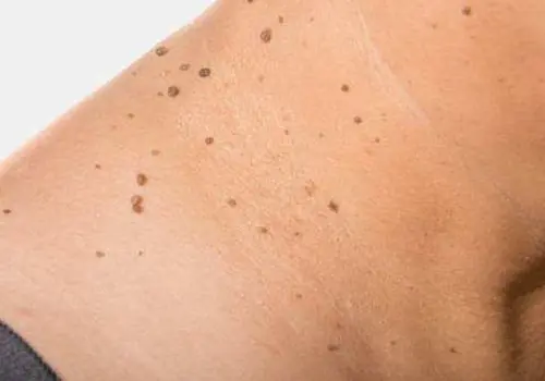 Noticing tiny bumps on your neck? Here’s what they could mean