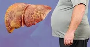 Your Liver Is in Danger: 10 Common Habits Behind Fatty Liver (You Might Be Doing #1 Daily)