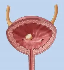 Subtle Early Signs of Bladder Cancer Most People Overlook
