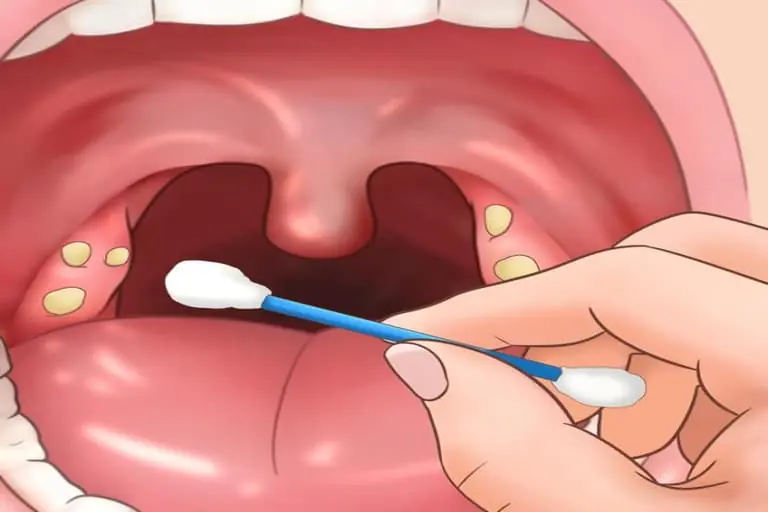 Everything you should know about tonsil stones and how to get rid of them
