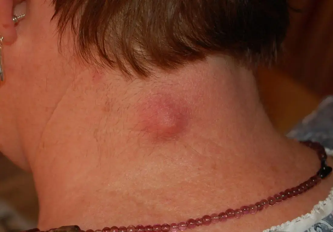 "My Son Woke Up With a Painful Lump on His Neck”: What Parents Should Know