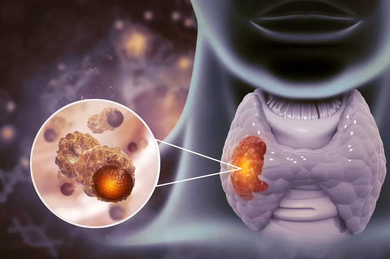 Avoid These 6 Foods If You Want to Protect Your Thyroid Health