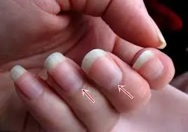 3 Nail Warning Signs That Could Signal Underlying Health Conditions