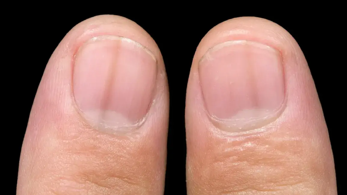 Your Nails May Be Showing Signs of Vitamin Deficiencies or Health Issues