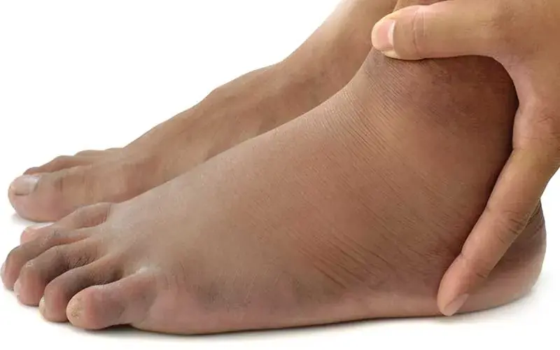 5 Unusual Signs in Your Feet That May Indicate Kidney Problems