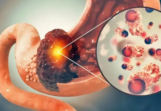 6 Early Signs of Stomach Can.cer You Should Never Ignore – Recognizing Them Could Save Your Life