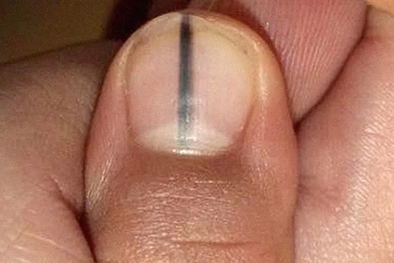 War.ning signs on your fingernails that may indicate health problems